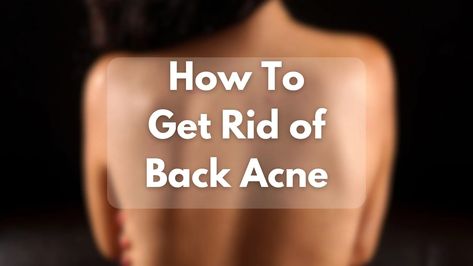 How to get rid of back acne fast with proven home remedies and lifestyle changes. Discover how to prevent bacne and achieve clear skin. Get Rid Of Back Acne, Rid Of Back Acne, Shoulder Acne, Back Acne Remedies, Chest Acne, Fresh Aloe Vera Gel, Back Acne, Proper Hygiene, Golden Rules