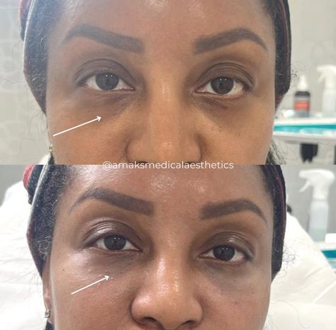 With our expert tear trough correction using premium fillers, you can enjoy an instant transformation:

🌟 Immediate Results
💧 Brighter, Youthful Eyes
✨ Rested & Refreshed Appearance
🚫 No More Hollow Under Eyes

📲 (917) 701-0253 
📞 (585)441-3838 Hollow Under Eyes, Under Eye Fillers, Tear Trough, Under Eyes, No More