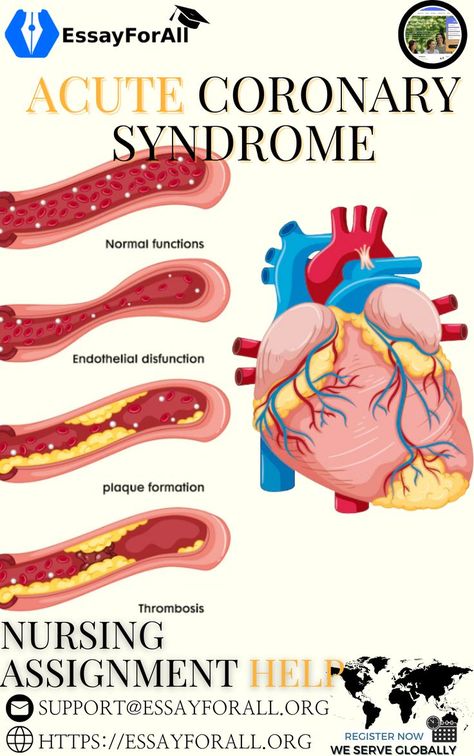 Acute Coronary Syndrome, College Paper, Nursing School Notes, Nursing Education, Nursing Notes, Assignment Help, Homework Help, School Notes, Medical Advice