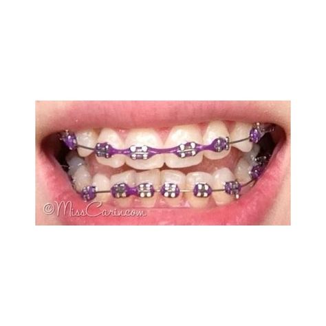 Violet Braces, Dark Purple Braces, Purple Braces, Braces Colours, Cute Braces Colors, Cute Braces, Brace Face, Braces Colors, Dental Braces