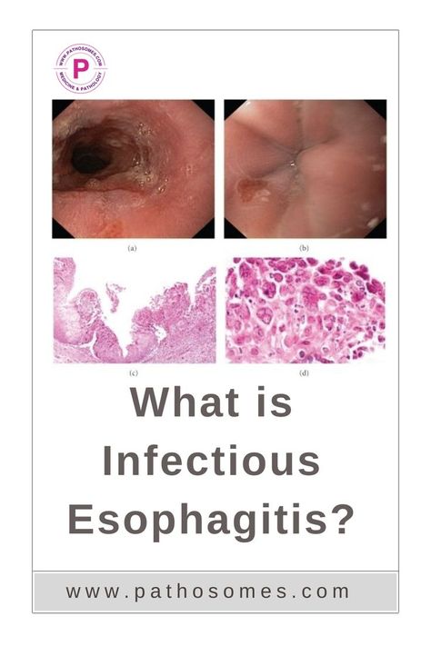 Infectious Esophagitis Esophageal Spasm, Preventative Health, Fungal Infection, Med School, Get Healthy, Home Remedies, Natural Remedies, Disease, Medicine