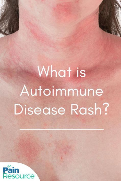 Autoimmune skin diseases create many symptoms. They include: Blisters Fatigue Lesions Increased sensitivity to sun exposure Muscle weakness Pain and sensitivity Rashes Scarring Scaly patches Sleep disturbances #HealthTipsSites Hashimotos Disease Symptoms, Body Rash, Autoimmune Disease Symptoms, Skin Symptoms, Health Chart, Invisible Disease, Sjogrens Syndrome, Hashimotos Disease, Mast Cell