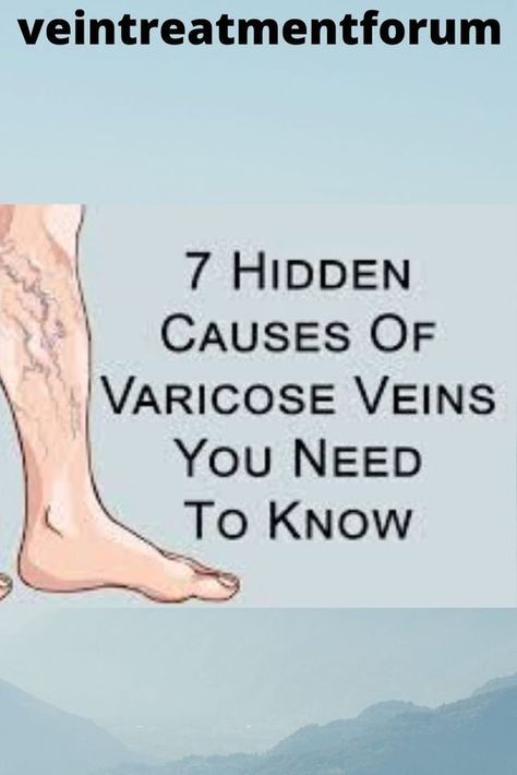 All about Varicose Veins! Vericous Veins, Varicose Veins Causes, Vein Health, Varicose Vein Removal, Varicose Vein Remedy, Leg Veins, Vein Removal, Cider, Aloe Vera