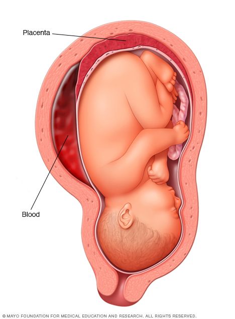 Placenta Abruption, Nurse Art, Human Anatomy And Physiology, Mayo Clinic, Anatomy And Physiology, Pregnancy Week By Week, Human Anatomy, Anatomy, Human