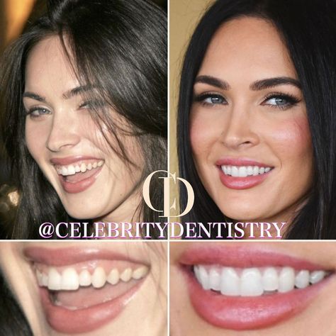 Teeth Makeover, Celebrity Teeth, Perfect Smile Teeth, Romantic Perfume, Teeth Aesthetic, Dental Bonding, Veneers Teeth, Beautiful Teeth, Cosmetic Injectables