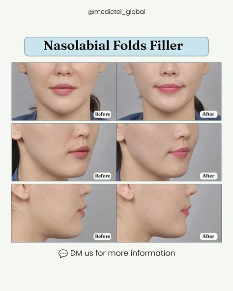 Understanding Nasolabial Folds: Causes and Solutions ⤵️ Nasolabial folds, those smile lines we all recognize, deepen as we age 🕰️ Why do they form?  ▪️ Natural aging reduces facial fat and skin elasticity  ▪️ Frequent smiling and talking contribute to these lines  ▪️ Sun exposure and smoking can accelerate their development How can you soften them? Dermal Fillers like Artecoll: Provides durable, long-lasting smoothing Laser Treatments: Boosts collagen without injections Topical Cr... Plastic Surgery Korea, Nasolabial Folds, Smile Lines, Natural Aging, Facial Exercises, Medical Tourism, Breast Augmentation, Anti Aging Treatments, Dermal Fillers