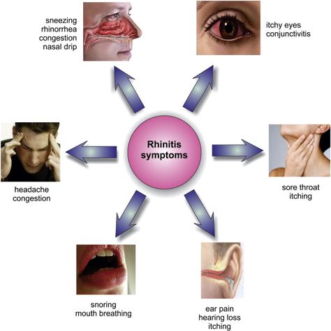 Allergic rhinitis, also known as hay fever, is a type of inflammation in the nose which occurs when the immune system overreacts to allergens in the air. Signs and symptoms include a runny or stuffy nose, sneezing, red, itchy, and watery eyes, and swelling around the eyes. Fever Symptoms, Allergy Shots, Allergic Rhinitis, Hay Fever, Asthma Symptoms, Watery Eyes, Itchy Eyes, Pulmonary Disease, Stuffy Nose