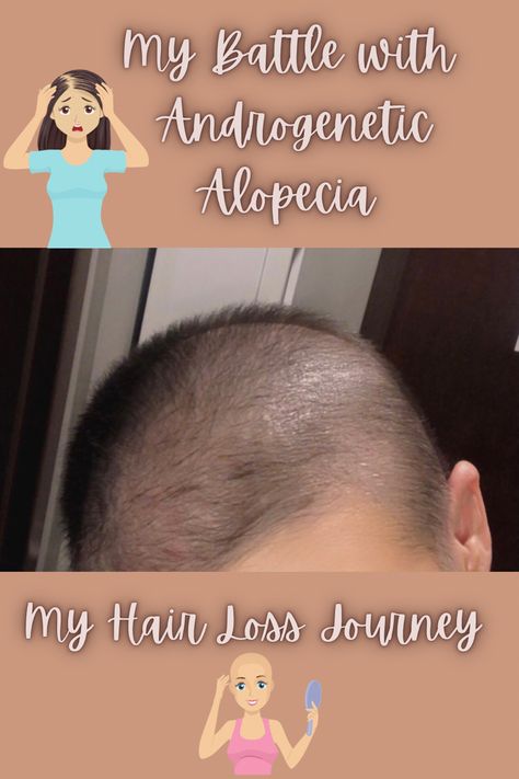 Myself with a bald head. Grow Hair Back, Alopecia Hair Growth, Alopecia Hairstyles, Androgenic Alopecia, Female Pattern Baldness, Androgenetic Alopecia, Loss Hair, Scalp Serum, Pattern Baldness