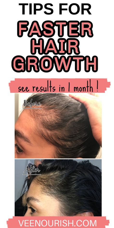 Hair Regrowth Grow Baby Hair, Hair Regrowth Remedies, Postpartum Tips, Hair Regrowth Women, Postpartum Hair, Get Thicker Hair, Overnight Hairstyles, Hair Growth Secrets, Hair Regrowth Treatments