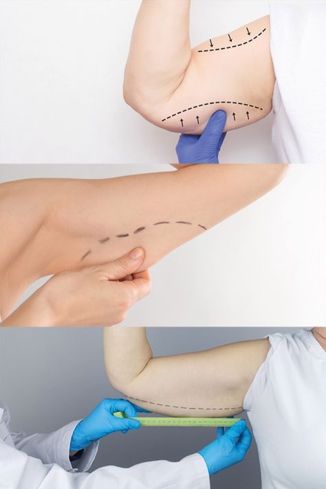 Turkeyana Clinic - Arm Lift Surgery (Brachioplasty) Arm Lift Surgery, Botox Injection Sites, Injection Sites, Botox Injection, Arm Lift, Excess Skin, Botox Injections, Compression Garment, Cosmetic Procedures