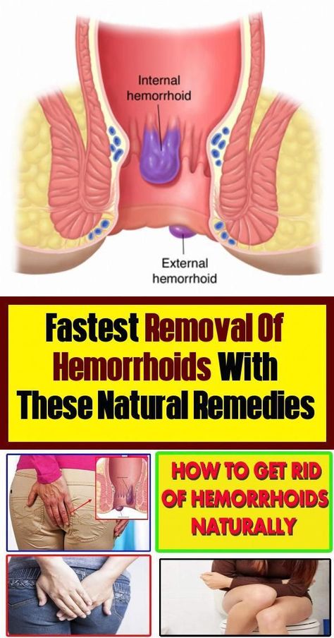 Fastest Removal of Hemorrhoids With These Natural Remedies ! Keno, Health Articles, Wellness Tips, Health Remedies, Herbal Remedies, Healthy Tips, Womens Health, Natural Health, Home Remedies