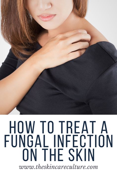 Fungal Infection Remedies, Eyelash Serums, Skin Fungus, Tinea Pedis, Goat Milk Lotion, Fungal Infection Skin, Stick Deodorant, Summer Skin Care, Types Of Fungi