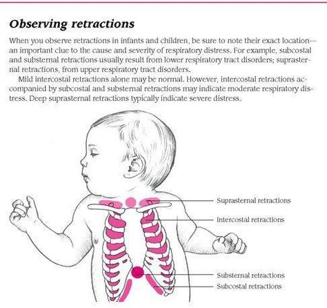 Retractions Respiratory, Lung Compliance, Nicu Nurse Education, Thoracic Cage, Neonatal Nursing, Online Flashcards, Nicu Nursing, Nursing Study Tips, Newborn Nursing