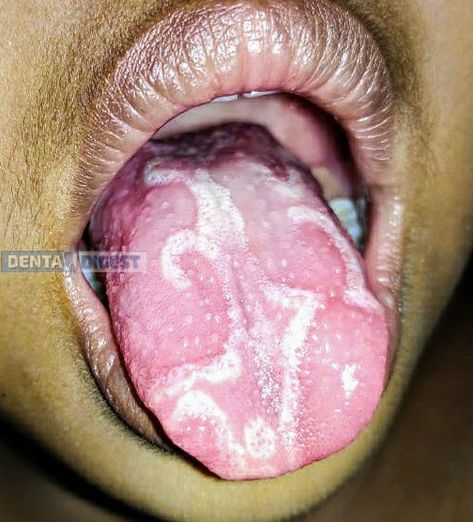 Geographic tongue is a benign inflammatory condition affecting the superficial surface of the tongue. In most cases the aetiology is unknown. Tongue Infection, Tongue Pictures, Multivitamin Supplements, The Tongue, Natural Pain Relief, Bacterial Infection, Fungal Infection, Oral Hygiene, Warning Signs