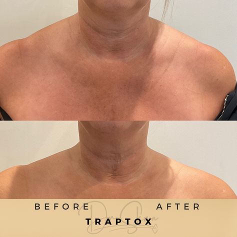 Relax and Unwind: TrapTox Botox for Tension Relief | Dr. Sknn Wilmslow Botox Trapezius, Traptox Before And After, Trapezius Muscle, Aesthetics Clinic, Botox Face, Muscle Relaxation, Botox Injections, Aesthetic Medicine, Body Modification