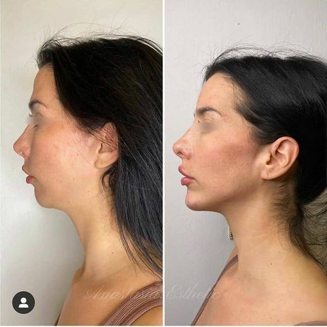 Forehead Filler, Nose Fillers, Face Transformation, Chin Implant, Rhinoplasty Nose Jobs, Face Fillers, Pretty Nose, Facial Surgery, Beauty Procedures