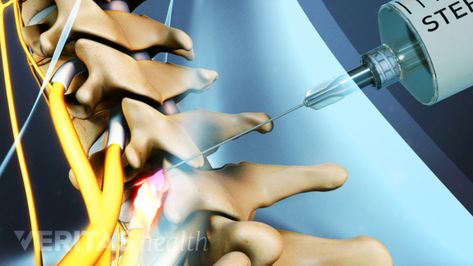 A selective nerve root block injection administers an anesthetic or anesthetic with steroid near the spinal nerve as it exits the intervertebral foramen. The medication reduces inflammation and numbs the pain transmitted by the nerve. Cervicogenic Headache, Occipital Neuralgia, Medical Intuitive, Spinal Nerve, Spine Health, Spine Surgery, Nerve Pain, Natural Health Remedies, Shoulder Pain