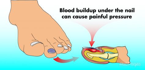 Stubbing your toe or catching a fingernail can cause a blood blister to form under the skin. Relieving the pressure is a simple and painless procedure that can prevent complications from occurring. Blister Remedies, Blood Blister, Nail Falling Off, Baking Soda Cleaning, Old Blood, Under The Skin, Genetic Disorders, Blood Vessels, Emergency Medical