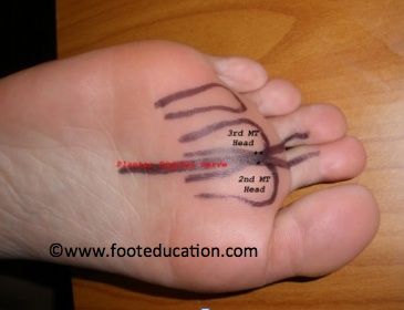 Location of Nerves causing Mortan's Neuroma Ankle Anatomy, Nerve Pain Remedies, Kwas Moczowy, Morton's Neuroma, Nerve Health, Chronic Pain Relief, Complex Regional Pain Syndrome, Foot Pain Relief, Decrease Inflammation