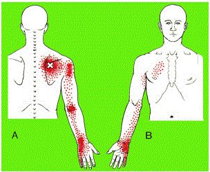 Pinched Nerve Relief, Nerve Pain Remedies, Cervical Disc, Myofascial Pain Syndrome, Neck And Shoulder Exercises, Cervical Pain, Neck And Shoulder Muscles, Cervical Spondylosis, Nerve Health