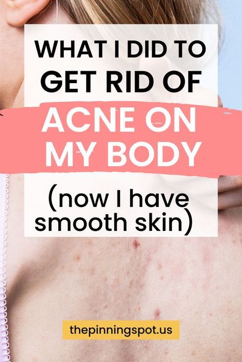 What I did to get rid of body acne for good (I have smooth body skin) Clear Body Acne, Smooth Body Skin, Get Rid Of Body Acne, Clear Back Acne, Skin Treatments For Acne, Shoulder Acne, Smooth Skin Body, Treatments For Acne, Cystic Acne Remedies