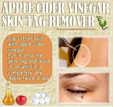 Apple Cider Vinegar Skin Tag Remover Pictures, Photos, and Images for Facebook, Tumblr, Pinterest, and Twitter Skin Tags Apple Cider Vinegar, Apple Cider Vinegar Remedies, Remove Skin Tags, Apple Cider Vinegar For Skin, Remove Skin Tags Naturally, Tag Remover, Skin Growths, Skin Tags, Organic Apple Cider