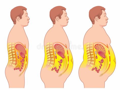 Obesity. Medical illustration of the consequences of obesity , #sponsored, #Medical, #Obesity, #illustration, #obesity, #consequences #ad 5 Day Diet, One Week Meal Plan, Gm Diet, Calorie Meal Plan, Visceral Fat, Lose 15 Pounds, 1200 Calories, Abdominal Fat, Medical Illustration