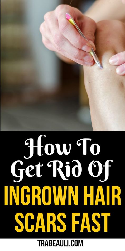 Get Rid Of Ingrown Hair Scars Ingrown Hair Scar Removal, How To Remove Ingrown Hair, Remove Ingrown Hair, Getting Rid Of Scars, Ingrown Hair Removal, Body Skin Care Routine, Ingrown Hair, Body Skin, Body Skin Care