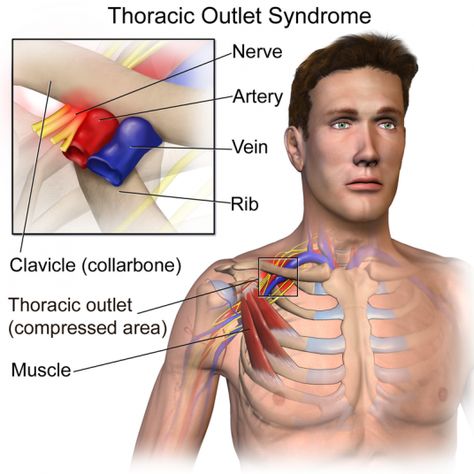 Thoracic Outlet Syndrome - Learn the causes and types of TOS and how to diagnose and best way to treat TOS Thoracic Outlet, Nerve Disorders, Subclavian Artery, Lymph Massage, Human Anatomy And Physiology, Sciatic Nerve Pain, Sciatic Nerve, Spinal Cord, Nerve Pain