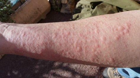 Wilderness Emergency Medicine | In-The-Field First Aid In A Pinch allergic reaction Hives Causes, Chronic Hives, Scale Skin, Anti Itch, Emergency Medicine, Emergency Prepping, Survival Food, Wilderness Survival, Itchy Skin