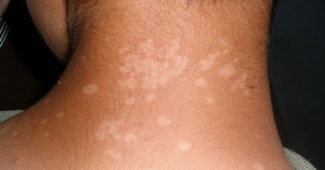 Hypopigmentation Tinea Versicolor, Fungal Infection Skin, Organic Skin Care Routine, Fungal Infection, Skin Remedies, Skin Diseases, Skin Care Remedies, Natural Home Remedies, Natural Treatments