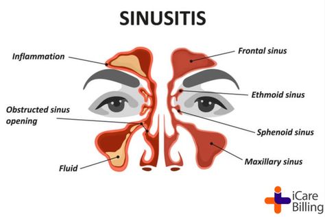 Sinus Pressure Relief, Remedy For Sinus Congestion, Sinus Inflammation, Sinus Drainage, Home Remedies For Sinus, Relieve Sinus Pressure, Paranasal Sinuses, Maxillary Sinus, Sinus Congestion Relief