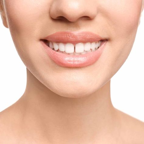 Teeth Gap Fillings: Reduce Gaps and Achieve a Beautiful and Healthy Smile Desired Smile, Teeth Gap, Smile With Teeth, Teeth Bonding, V34 Colour Corrector, Retainer Teeth, Pretty Teeth, Dental Bonding, Colour Corrector