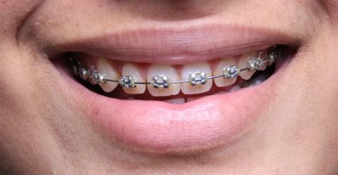 Clear Braces Vs Mini Diamond Braces - There used to be only one type of… #FortWaltonBeach Ceramic Braces, Types Of Braces, Mouth Guard Sports, Traditional Braces, Clear Braces, Metal Braces, Fort Walton Beach, Braces, Keep It Cleaner