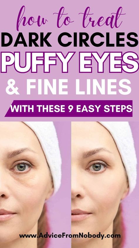 remedies for healthy nails Eye Bags Remedy, Tired Eyes Remedy, Undereye Bags Remedy, Get Rid Of Eye Bags, Big Brows, Rid Of Eye Bags, Eye Bag Remedies, Puffy Bags, Puffy Eyes Remedy