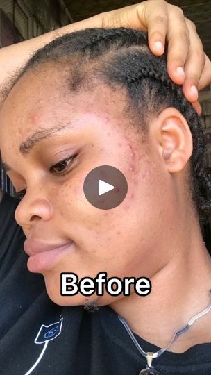 How To Reduce Pimples On Face, Small Pimples On Face, Pimple Hacks, Clear Pimples, Small Pimples, How To Clear Pimples, How To Reduce Pimples, Pimples On Face, Face Tips