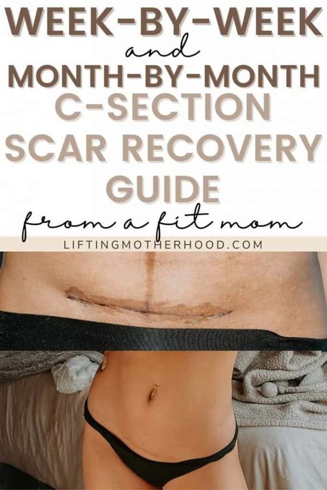 C Section Belly, After C Section Workout, C Section Scar, Post C Section, C Section Workout, Post Baby Workout, C Section Scars, C Section Recovery, Diastasis Recti Exercises