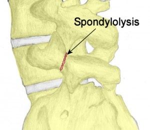 Pars Defect, Weird Looking Animals, Spine Problems, Cervical Spondylosis, Human Spine, Psoas Muscle, Spine Health, Nursing School Studying, Medical Knowledge