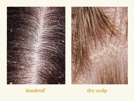 Dandruff vs. Dry Scalp: Causes, Symptoms, and Best Treatments Dry Scalp Vs Dandruff, What Is Dandruff, What Causes Dandruff, Home Remedies For Dandruff, Scalp Problems, Getting Rid Of Dandruff, Flaky Scalp, Hair Dandruff, Scalp Oil