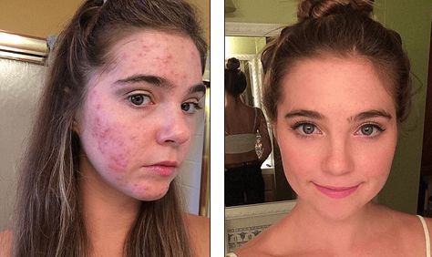 How We Cured Cystic Acne With One Simple Diet Change #cysticacneremedies Get Rid Of Cystic Acne, Treating Cystic Acne, Cystic Acne Remedies, Simple Diet, Acne Overnight, Natural Acne Remedies, Natural Acne, Severe Acne, Home Remedies For Acne