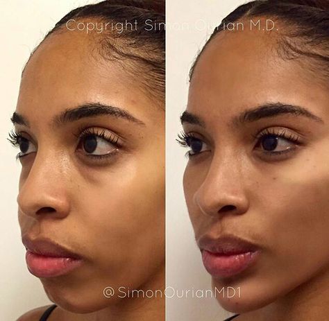 This 5-Minute Procedure Gives You the Same Feature That Successful People Have- Cosmopolitan.com Face Injections, Cheek Implants, Chin Filler, Chin Augmentation, Chin Implant, Cheek Lift, Face Fillers, Botox Before And After, Cheek Fillers