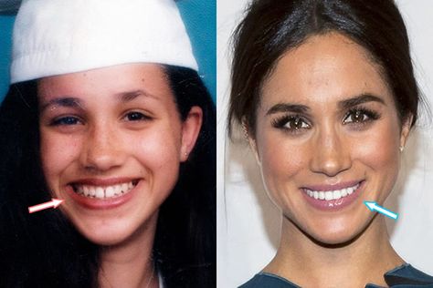 Meghan before and after new teeth veneers. Meghan Markle Nose Job, Meghan Markle Plastic Surgery, Jaw Reduction Surgery, Teeth Veneers, V Line Surgery, Harry And Meghan Wedding, Plastic Surgery Fail, New Teeth, Plastic Surgery Photos