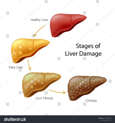 Stages of liver damage. Liver Disease. Healthy, fatty, liver fibrosis and Cirrhosis. Illustration isolated on white background. #Ad , #spon, #Liver#Disease#Healthy#Stages Liver Damage, Liver Diet, Liver Failure, Vitamin D Deficiency, Stem Cell Therapy, Cell Therapy, Healthy Liver, Scar Tissue, Liver Health