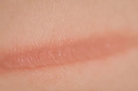 How to Get Rid of Burn Marks on the Skin with Home Remedies How To Remove Burn Marks On Skin, Burn Mark On Skin, Burn Scar Remedies, Burn Relief Skin, Burned Skin Remedies, Bloom Redesign, 2nd Degree Burns, Iron Burn, Burn Remedy