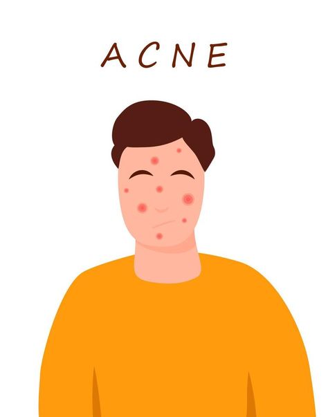 Cartoon teenage character with acne skin. Skin problems concept. Colorful vector illustration isolated on white background. Medicine and health care. Acne Illustration, Background Medicine, Skin Burns, Care Care, Cartoon Drawing, Acne Skin, Skin Problems, Skin Health, Cartoon Drawings