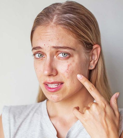 Shutterstock Cystic Acne Remedies, Skin Care Routine For 20s, Natural Acne Remedies, Home Remedies For Acne, Acne Causes, Acne Scar Removal, Acne Breakout, Cystic Acne, Acne Remedies