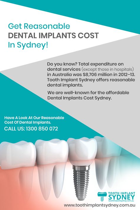 Tooth Implant, All On 4 Dental Implants, Best Dental Implants, Affordable Dental Implants, Dental Implant Surgery, Advanced Bionics Cochlear Implant, Dental Implants Cost, Dentist Appointment, Teeth Implants