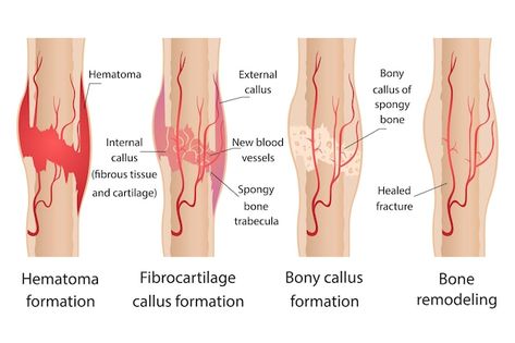 Bone Healing Process, Stages Of Healing, Medical Radiography, Fracture Healing, Skeleton Human, Bone Healing, Headache Causes, Hip Fracture, Bone Fracture