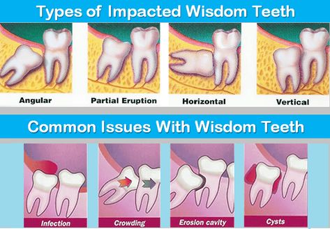 Do you know? 10 million impacted wisdom teeth are removed every year also 2%of people will get no wisdom teeth. After wisdom teeth removal Mission Hills, the recovery phase depending on your health may take two weeks or more. However, looking after the surgical area with proper care can help you heal better and quick. Soft Foods After Surgery Teeth, Wisdom Teeth Meme, Dentistry Notes, Dental Nursing, Wisdom Tooth Removal, Wisdom Teeth Recovery, Tooth Pain Remedies, Impacted Wisdom Teeth, After Wisdom Teeth Removal