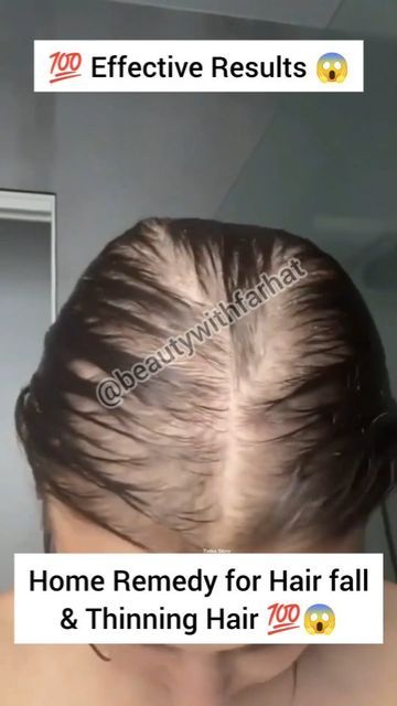 Hairfall Remedies Home, Bald Hair Growth, Thining Hair, Home Remedies For Dandruff, Hair Fall Remedy, Dandruff Remedy, Long Hair Tips, Arijit Singh, Hair Pack